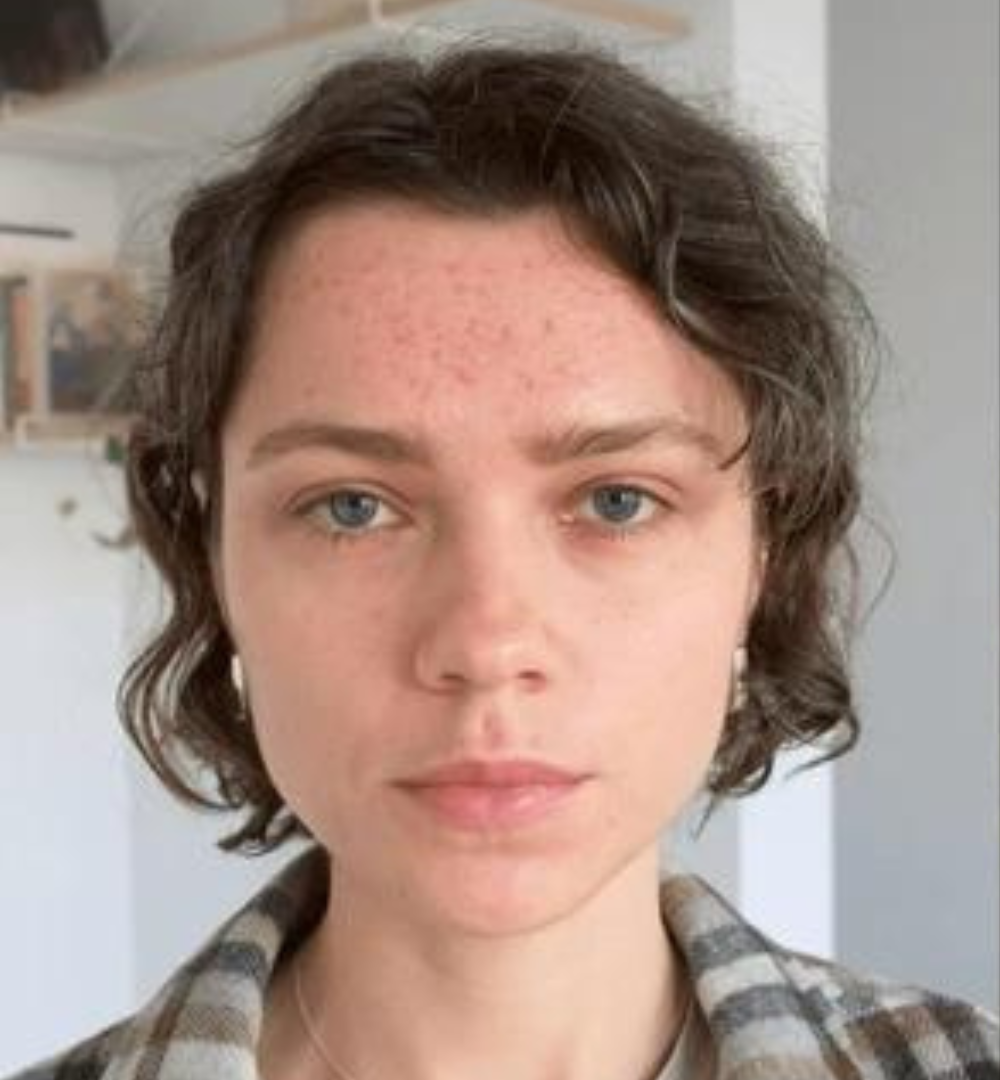 Before results showing improved skin clarity and glow with hydrogen water use.